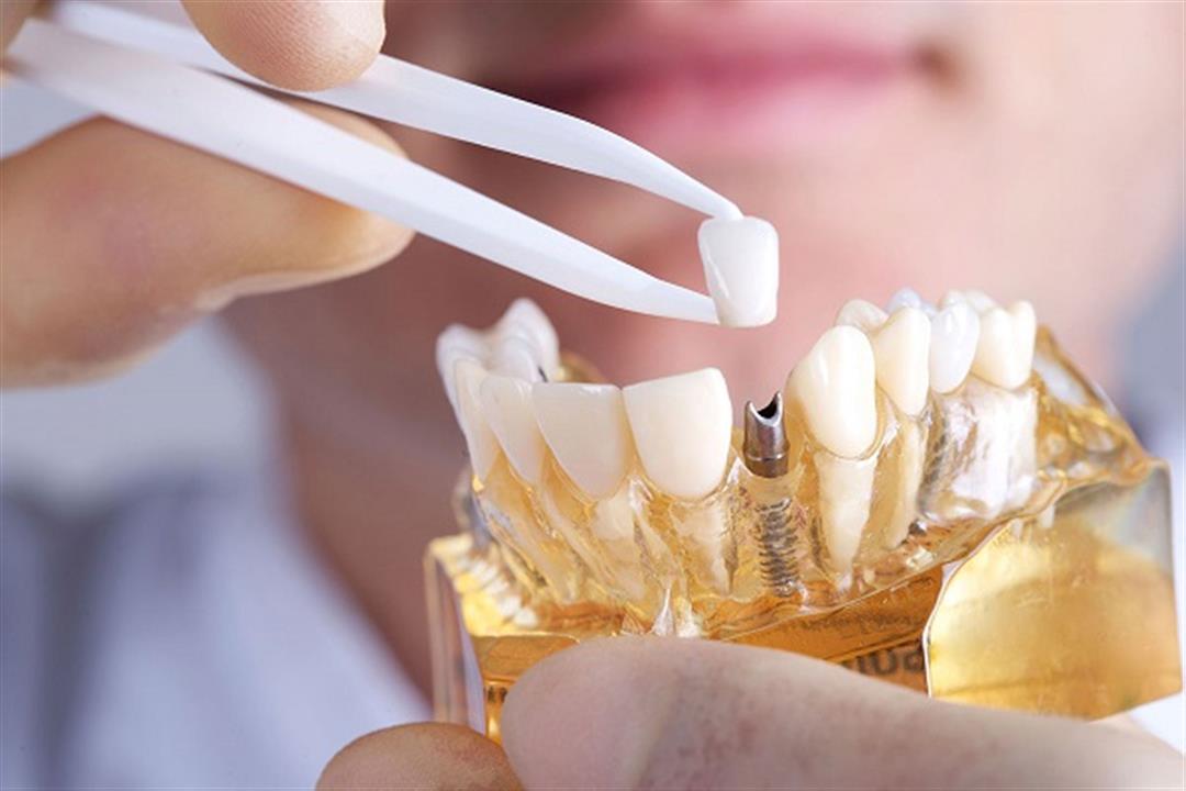 عيوب زراعة الأسنان وهل يحدث مشاكل العظام والنسيج الليثي ؟