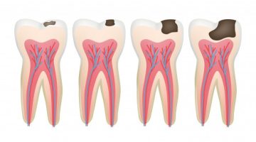 علاج تسوس الأسنان والوقاية منه