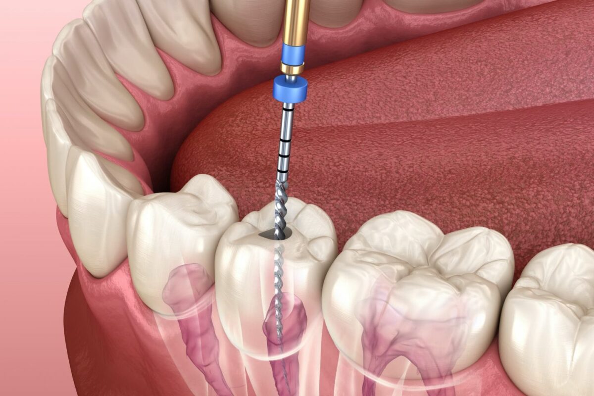عصب الأسنان والتهابه