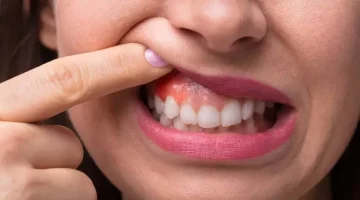 اسباب خراج الاسنان وأعراضه وعلاجه