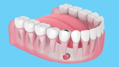 علاج خراج الأسنان