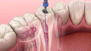 علاج عصب الأسنان وأسبابه