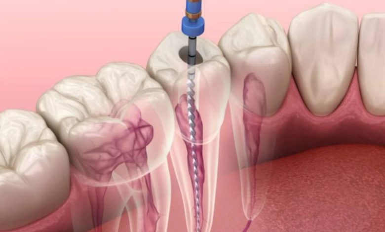 علاج عصب الأسنان وأسبابه